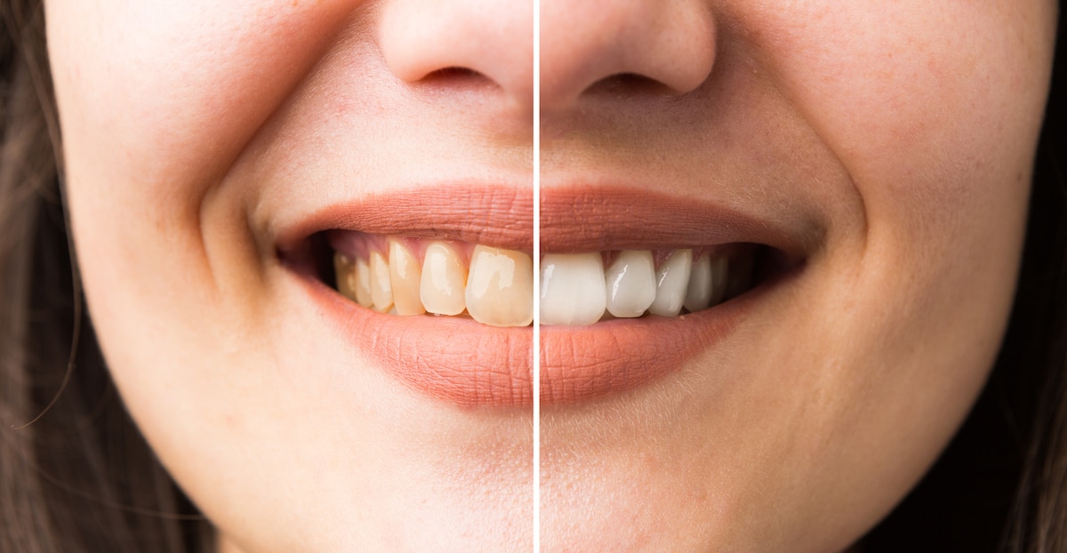 Before and After Teeth Whitening